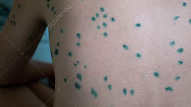 Child with Chickenpox Sores