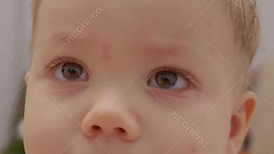 Child with chickenpox showing early signs and itching on skin