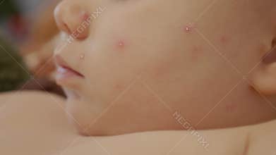 Child with chickenpox showing blisters on face in home setting