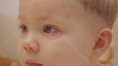 Child with chickenpox showing face and eyes up close