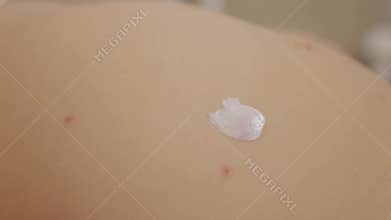 Applying ointment to treat chickenpox blisters on a child's skin