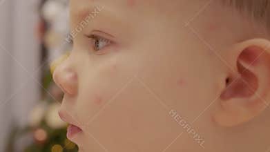 Close-up of child with chickenpox showing rash on face and skin