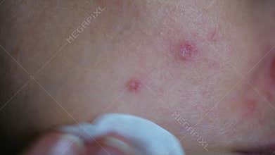 Person applying treatment cream to acne pimples on face