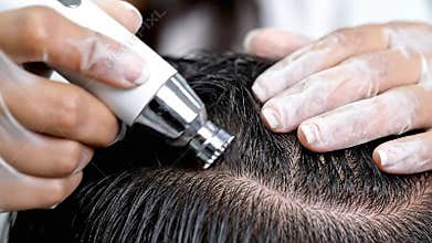 Close Up Scalp Treatment Microneedling Process for Hair Regrowth at Dermatology Clinic with White Gloves and Specialist Equipment