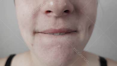 Woman with Acne Licking Her Lips Close-up