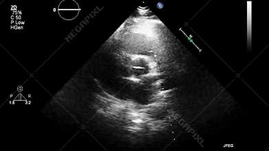 Ultrasound transesophageal examination of the heart.