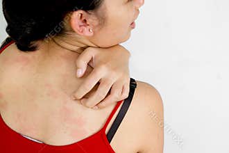 Ethic young woman back with itchy skin