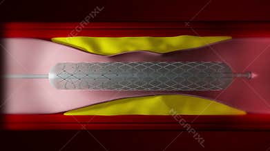 Angioplasty balloon overview