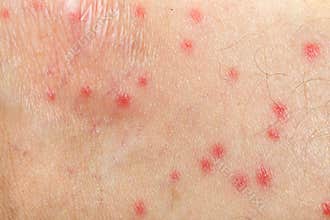 Mosquito allergy on human skin