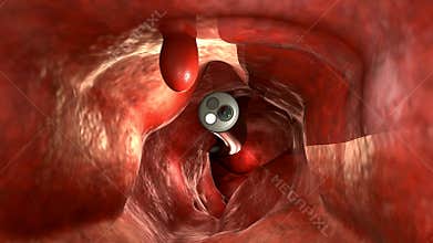 Endoscope with colonic polyp