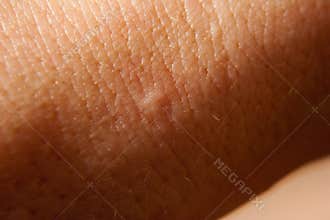 Bed bug bite