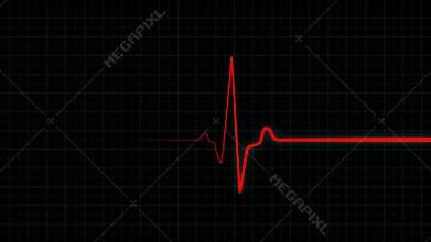 Patient`s death on ECG monitor