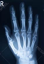 Xray of hand bones, right hand