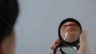 Woman apply cream with a cotton swab to a pimple on her face in the mirror. Close up. Acne, redness, blemish, blackheads. Skin car