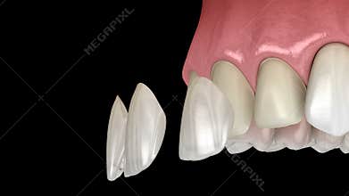 Veneer installation procedure over central incisor and lateral incisor