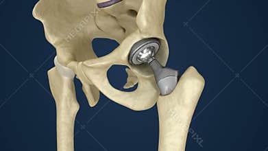 Hip replacement implant installed in the pelvis bone.