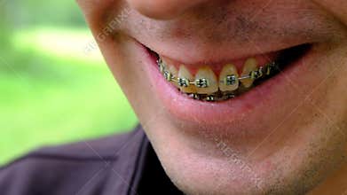 Brackets for yellowed teeth. Close-up of a smiling guy. The teeth of a smoking person. Shallow depth of field. Dental