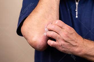Close up dermatitis on skin, ill allergic rash dermatitis eczema of patient , atopic dermatitis symptom skin detail texture ,