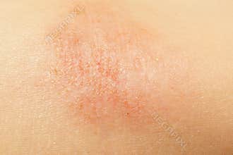Eczema on child skin