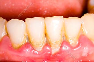 Dental tartar and plaque