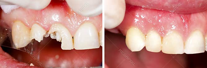 Destructed teeth filling