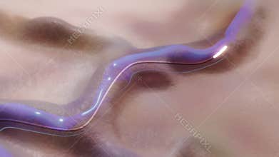 Endovenosus Thermal Ablation