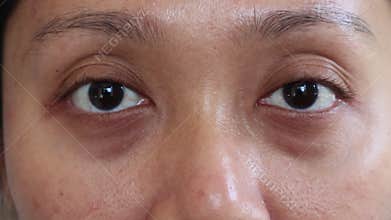 young woman face has dark bags under her eyes. Swelling of the lower eyelid and deep. Unhealthy appearance