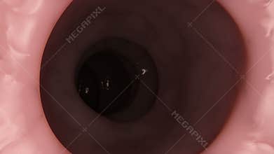 Diverticle from inside the colon