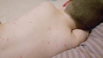 Child experiencing skin irritation chickenpox on the back important considerations for parents