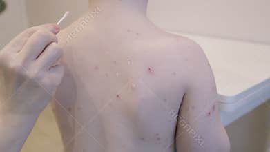 Child Suffering from Skin Condition chickenpox Accompanied by Lesions Present on Their Back