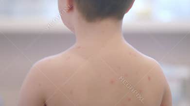 Child exhibiting symptoms associated with Chickenpox, a contagious childhood disease
