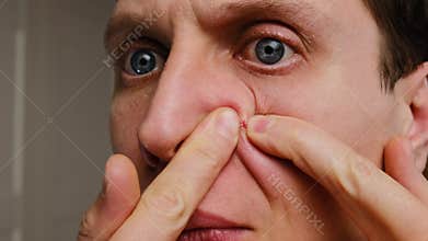 Close-up of a young man popping a pimple on his face, highlighting skin texture and a red blemish, emphasizing acne