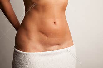 Stomach of a woman with scars