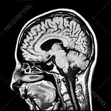 Human brain MRI scan