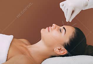 Acupuncture treatment to relieve stress and relax the body. Acupuncture is a traditional Chinese medicine