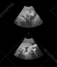 Fetus sonogram - 8 month