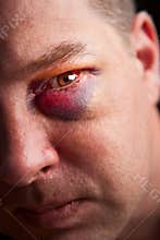 Black eye