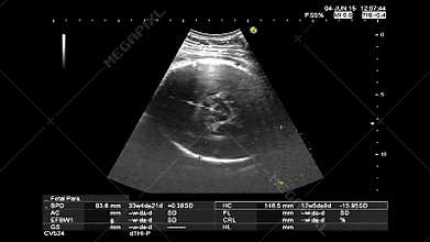 High quality ultrasound echography check. Fetus heartbeat recording and thermal analysis