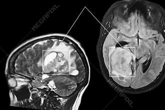 Brain cancer.MRI.
