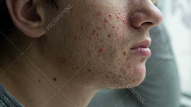 Acne on a face of a man
