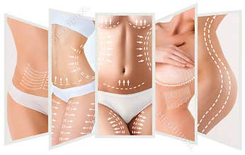 The cellulite removal plan. White markings on young woman body