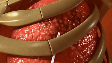 Removal of chest tumors