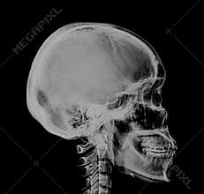 Human Skull Xray Negative Scan