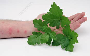 Poison ivy and rash