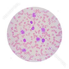 Microscopic view of a blood smear from leukemia patient showing