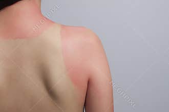 Sunburn effect on body without protect