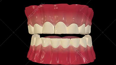 Bruxism condition overview