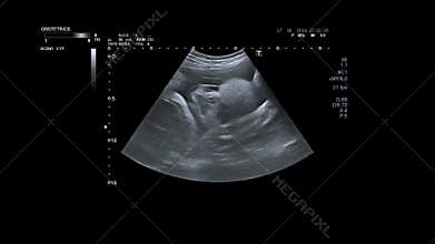 Ultrasonography of pregnant woman. Ultrasound of baby body and spine. Tiny baby is turning in mother`s belly. 32 weeks