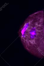 Screening for breast cancer
