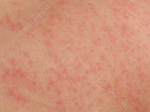 Skin rash